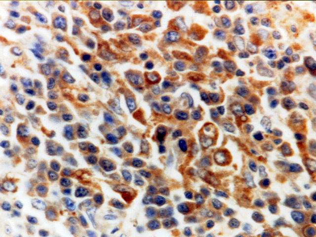 Fig.8: TRCBCL. CD68 - <div style=